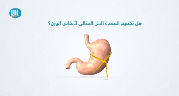 تكميم المعدة – مستشفى الرحمة تكميم المعدة - مستشفى الرحمة