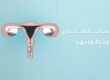 تكيس المبايض - مستشفى الرحمة