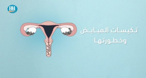 تكيس المبايض - مستشفى الرحمة