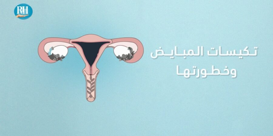 تكيس المبايض - مستشفى الرحمة